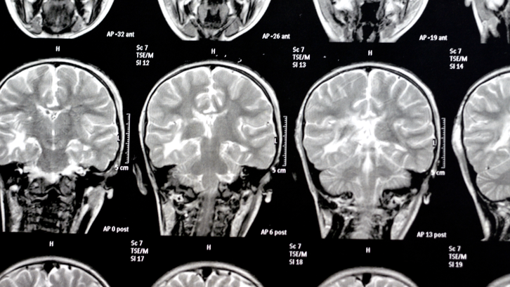 Ressonància magnètica del cervell