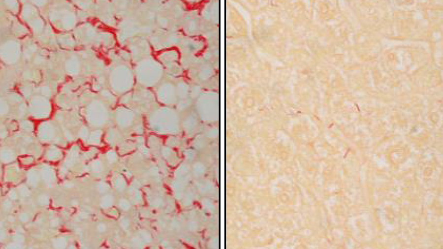 Tejido derivado del hígado con fibrosis hepática (izquierda) y después del tratamiento (derecha) (UAB)